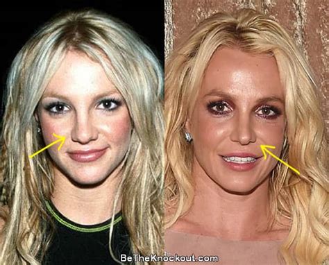 Britney Spears Nose Job 